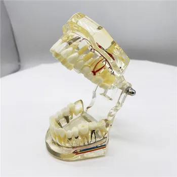 Dantų Dantų Modelio M2001-2 Naujas Implantas ir Restauravimo Modelio Mokymo Mokymo Modelis